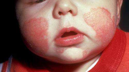 аллергия на продукты питания у детей как лечить