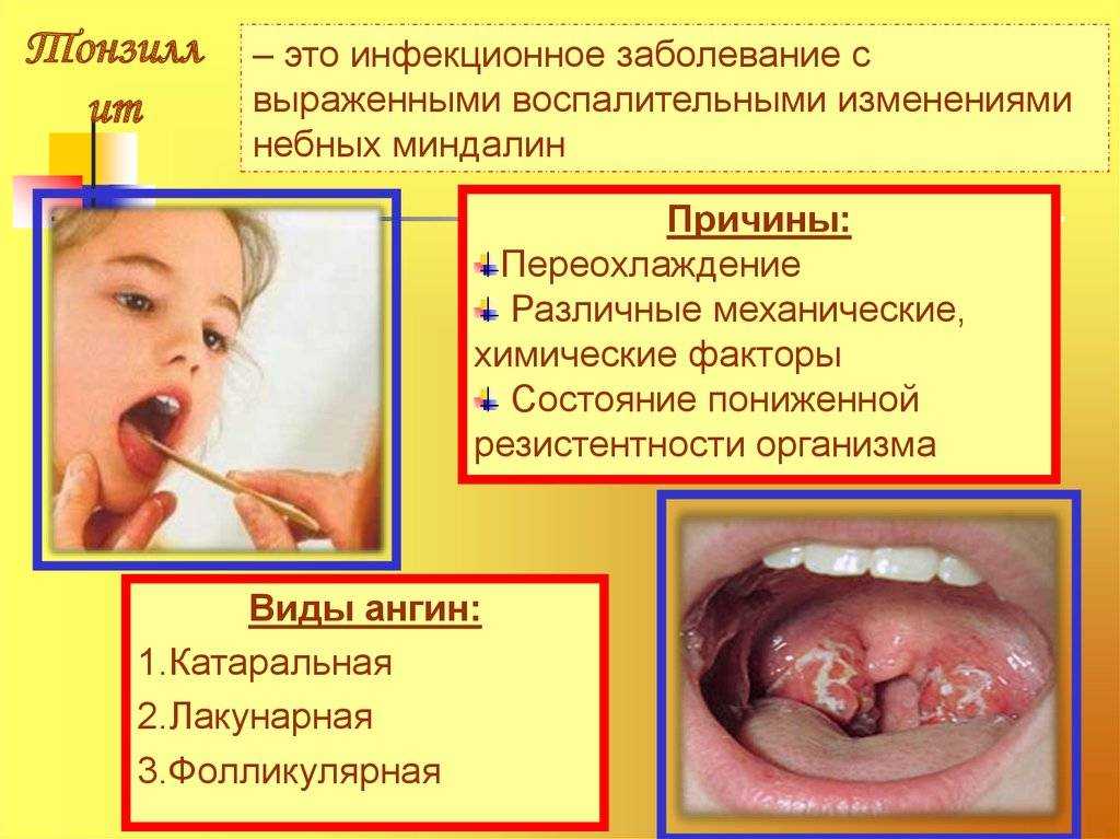 ангина у детей симптомы и лечение питание