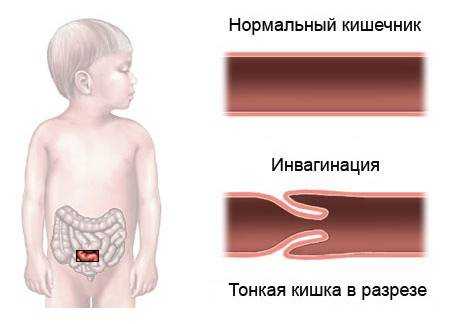 нарушение питания непроходимость кишечника у детей являются основными симптомами