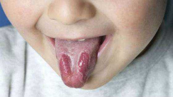 питание при молочнице во рту у детей