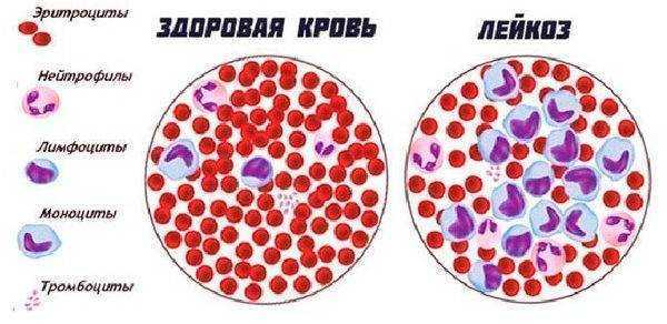 рак крови у детей питание