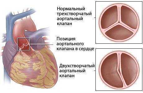 врожденный порок сердца у детей питание