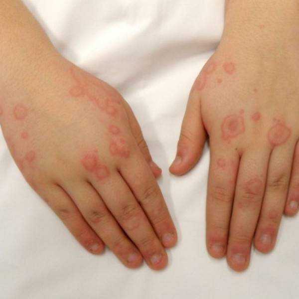 как быстро проявляется аллергия у детей на продукты питания